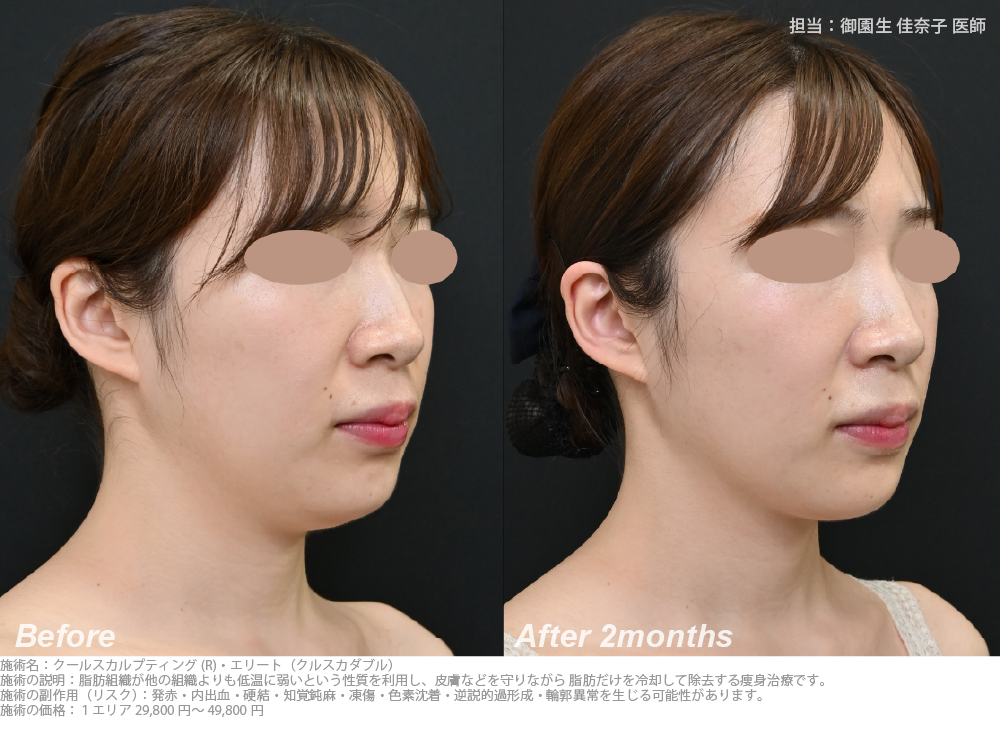 二重あごをすっきり整えてシャープなフェイスライン