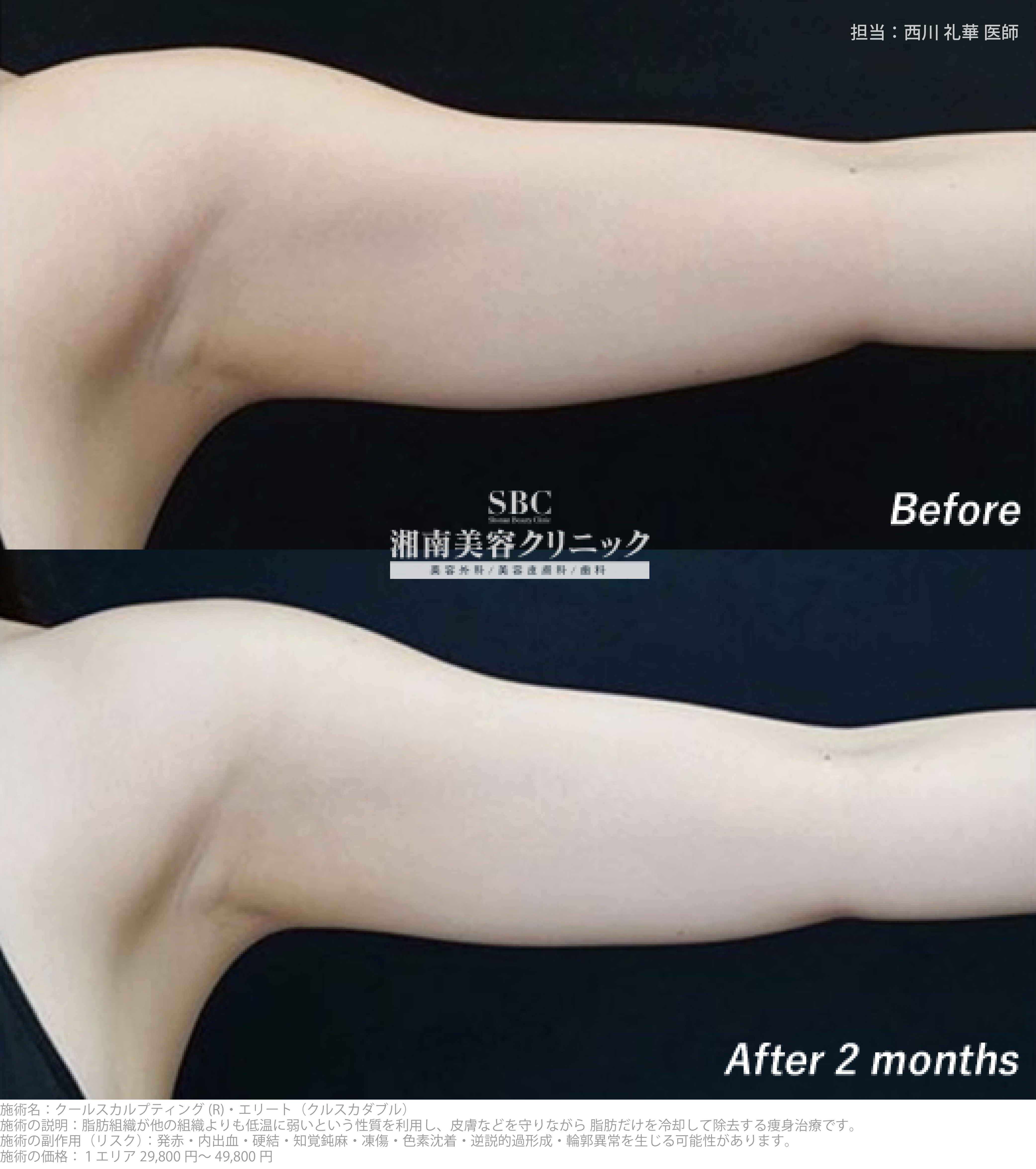 二の腕の“振袖脂肪”をすっきり引き締め