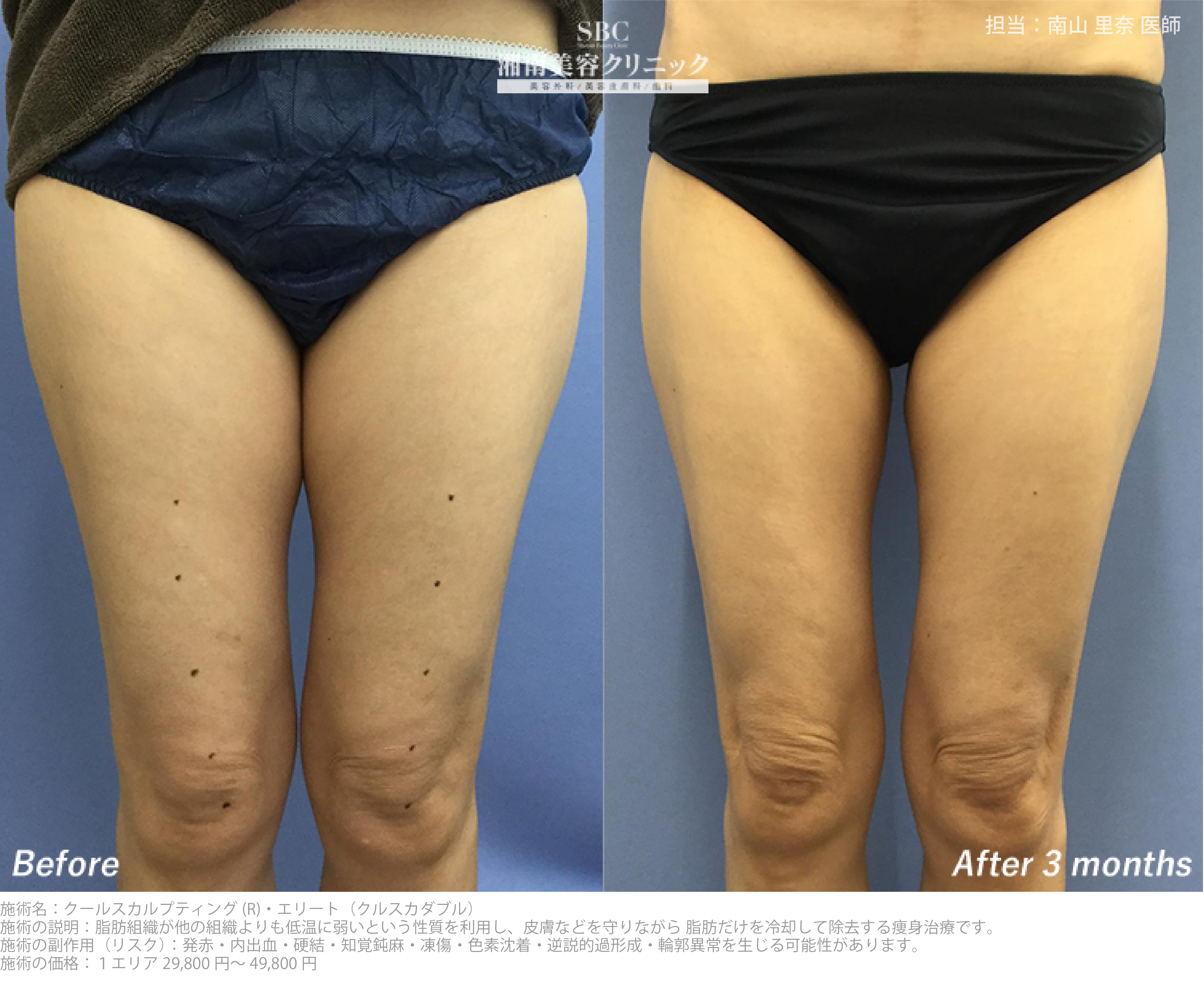 太ももの脂肪を減らしてすらっとした脚へ