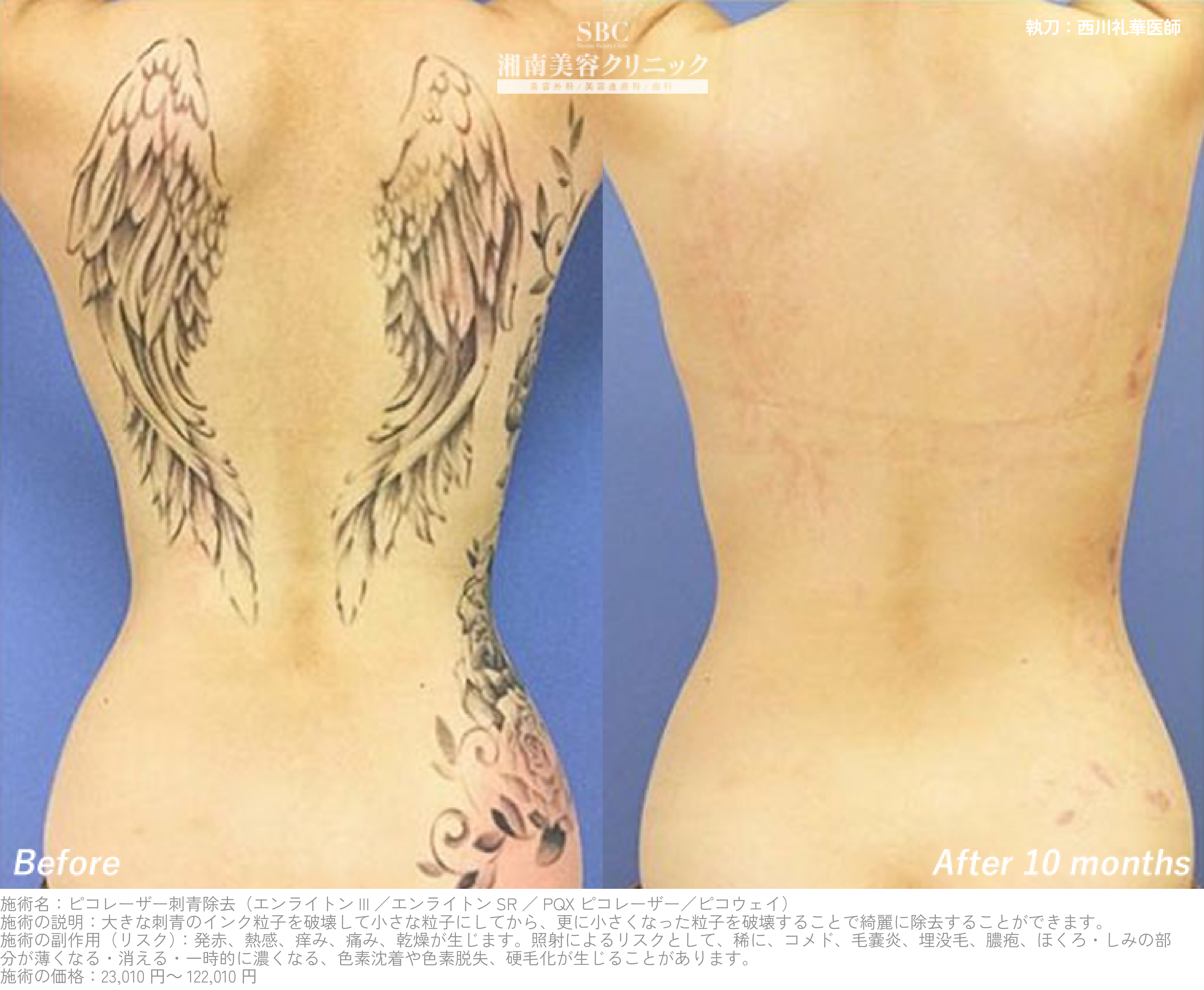 ピコレーザーによるタトゥー除去