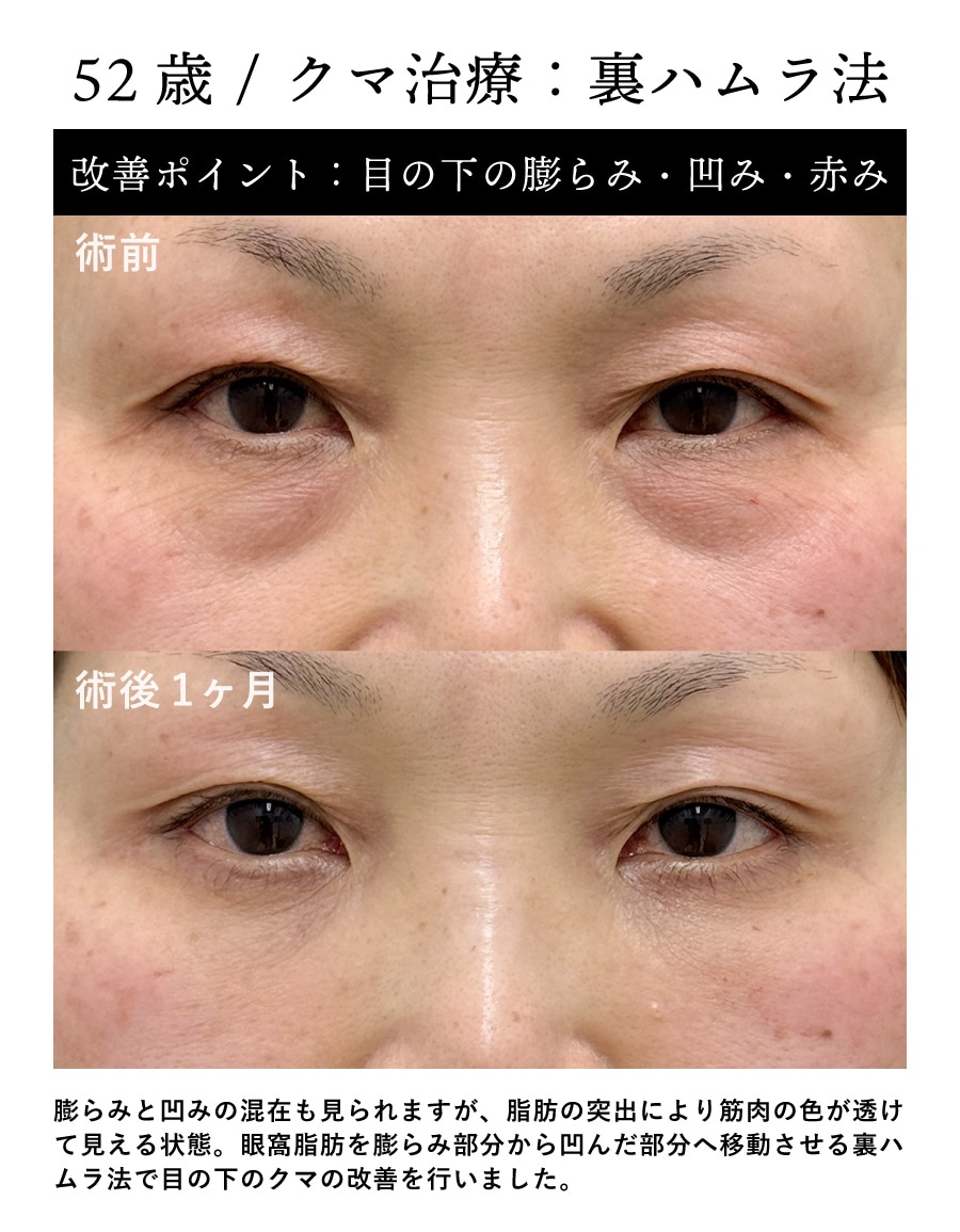 【黒クマ＋赤クマ改善】52歳 / 裏ハムラ法