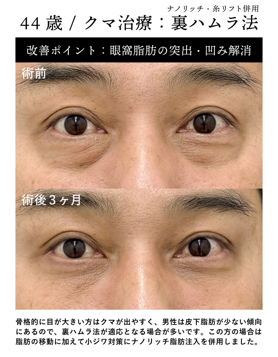 【黒クマ改善】44歳 / 裏ハムラ法+脂肪注入(ナノリッチ)+糸リフト
