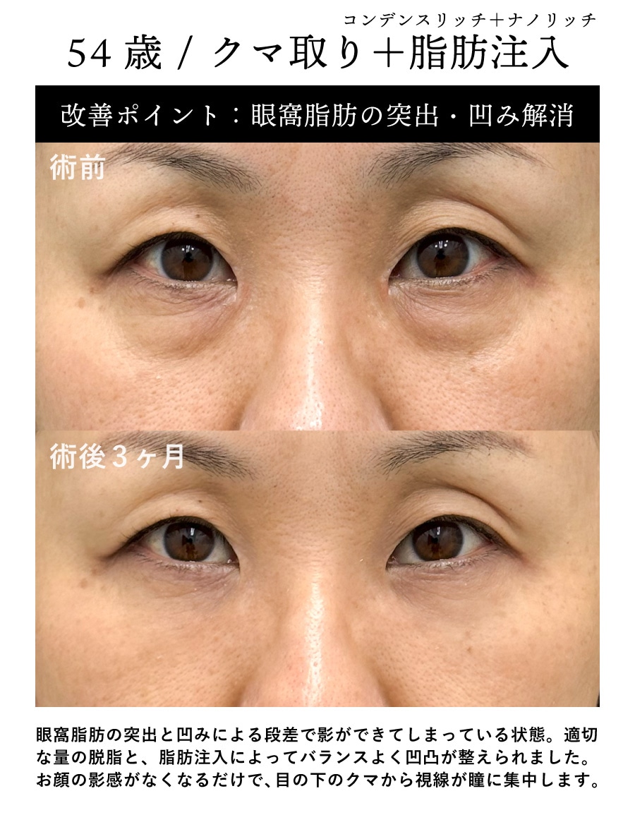 【黒クマ改善】54歳 / クマ取り＋脂肪注入<br>(コンデンスリッチ・ナノリッチ)