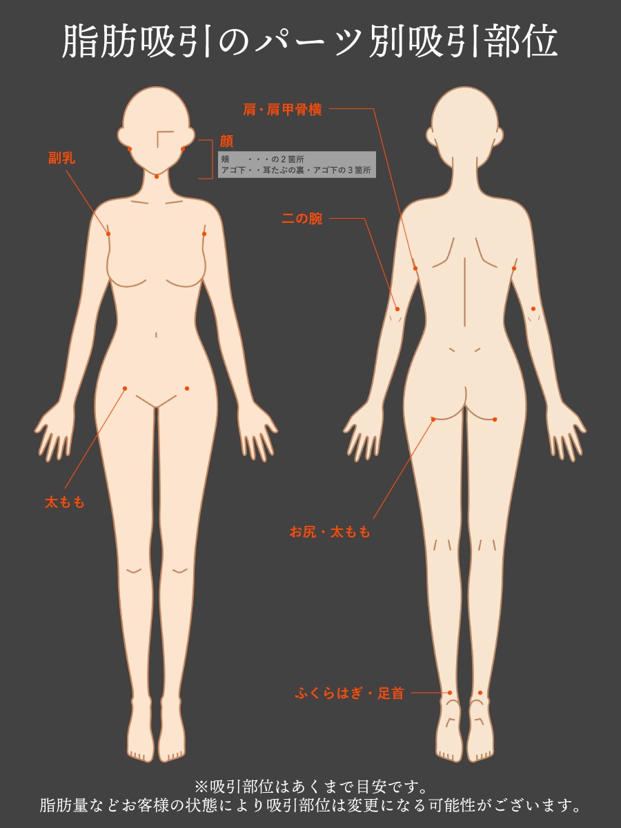 脂肪吸引ってどこから吸うの？傷跡はどの辺？