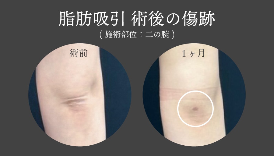 脂肪吸引の傷跡(手術痕)ってどんなもの？