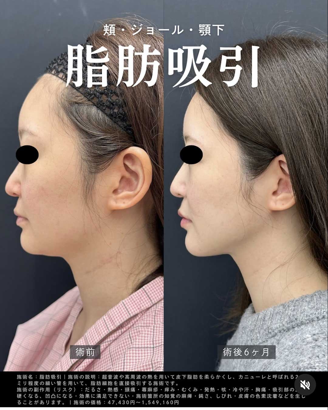 顔の脂肪吸引（ホホ・アゴ下）でスッキリとした小顔へ<br />
