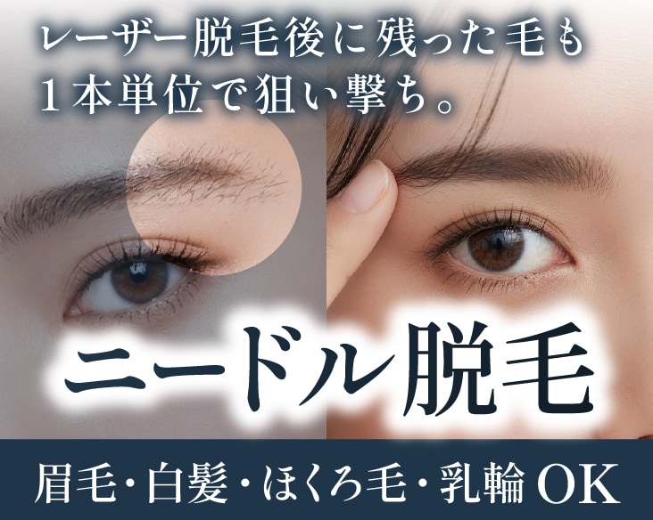 【京都でニードル脱毛】眉毛・白髪・ほくろ毛を永久脱毛！SBC京都駅ビル院の医療針脱毛を徹底解説！
