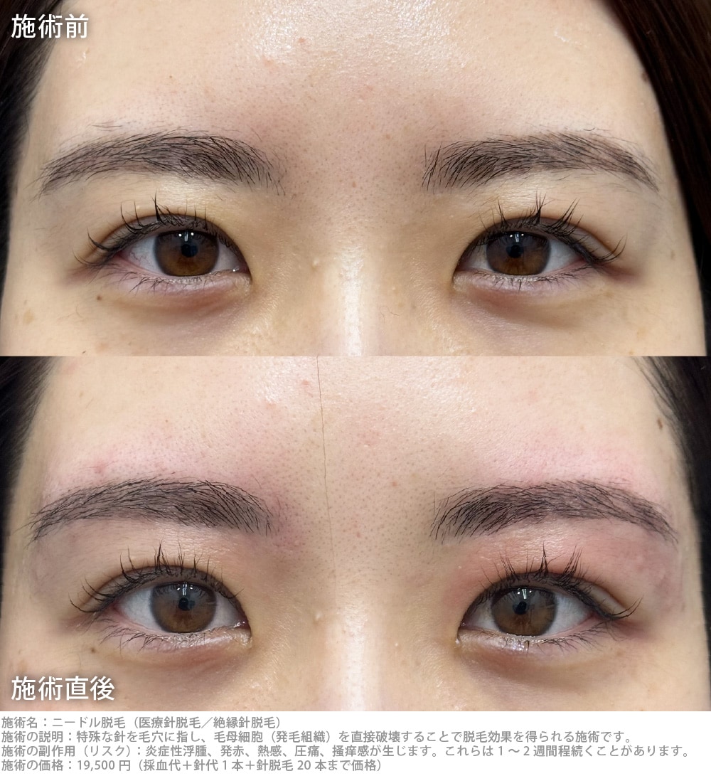 ぼやけていた眉の輪郭がくっきり！洗練された垢抜け眉へ