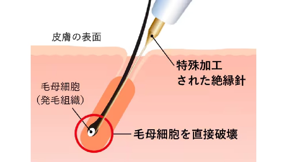 安全性の高い「絶縁針」を使用