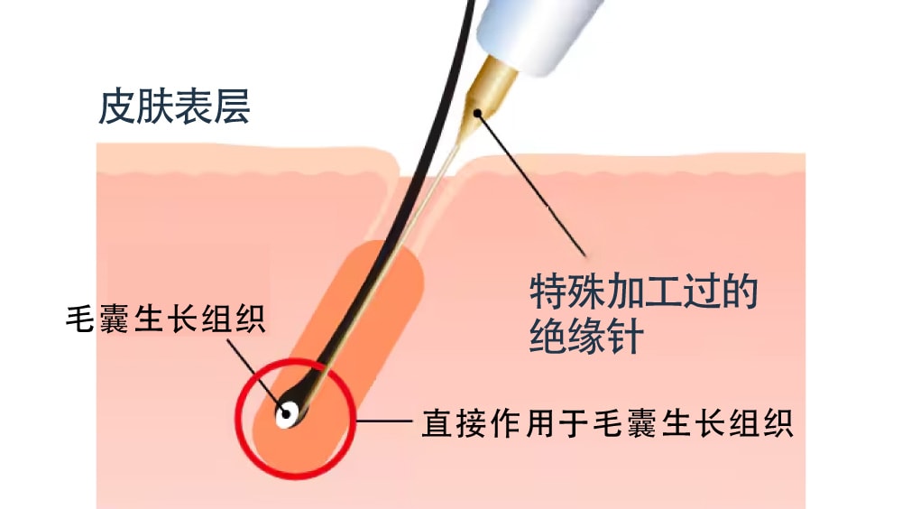 使用安全性更高的「绝缘针」