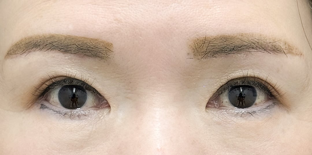 二重整形 40代 女性 術後