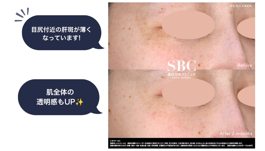 難治性の肝斑にアプローチできる！