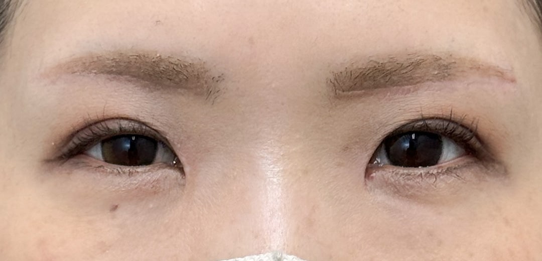 二重整形 30代 女性 術後