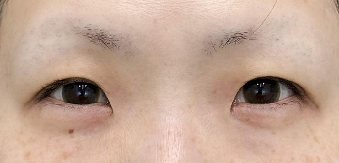 二重整形 30代 女性 術前