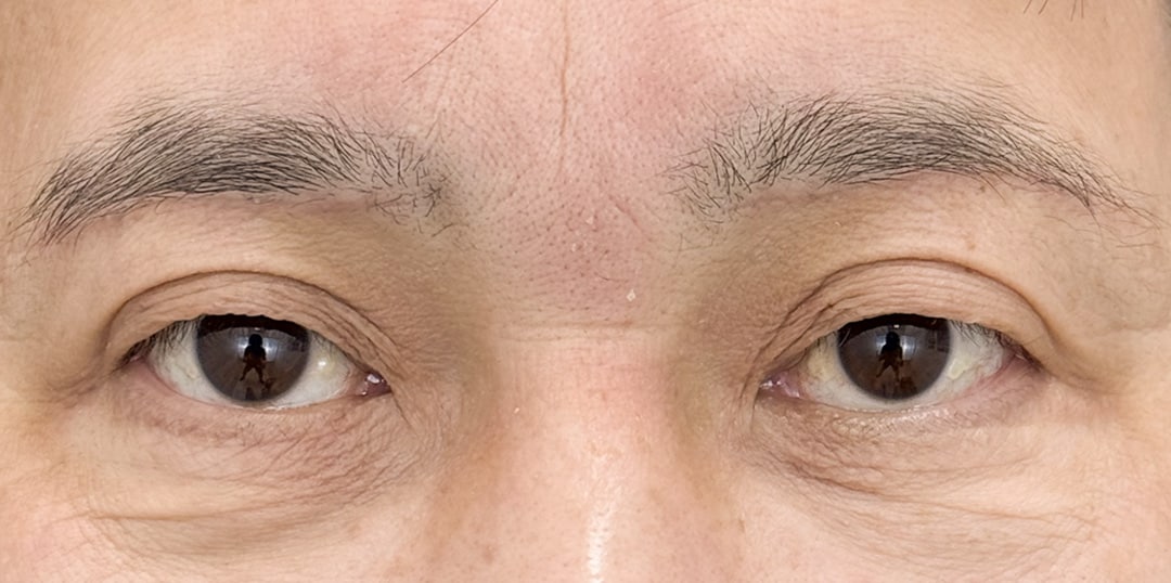 二重整形 50代 男性 術後