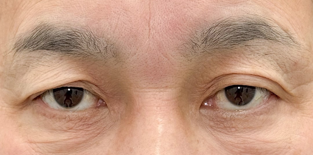 二重整形 50代 男性 術前