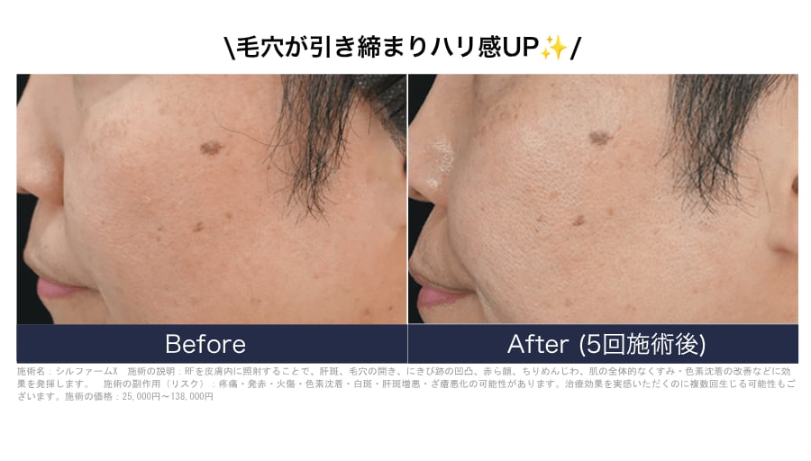 毛穴と小じわにも効果実感！<br />
