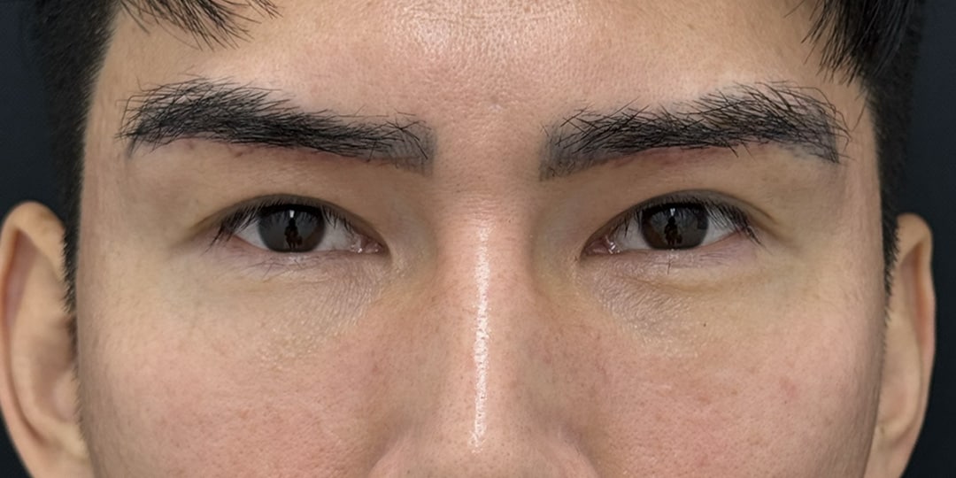 二重整形 30代 男性 術後