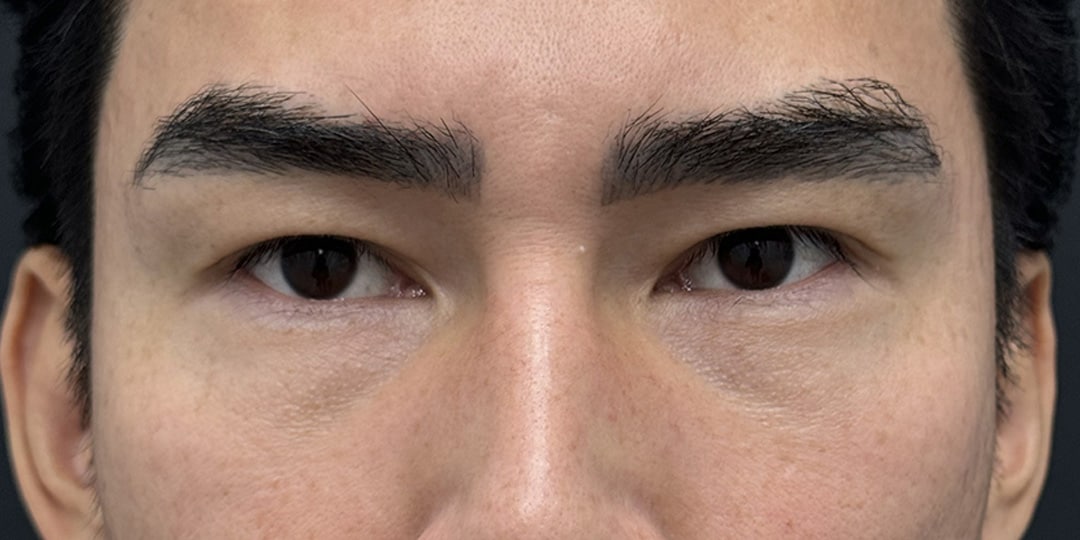 二重整形 30代 男性 術前