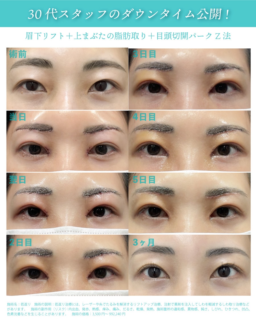 30代美容ナース【眉下リフト】経過レポ