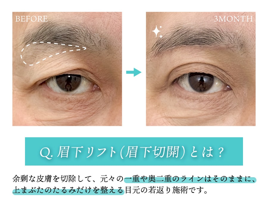 眉下リフト(眉下切開)とはどういう治療？