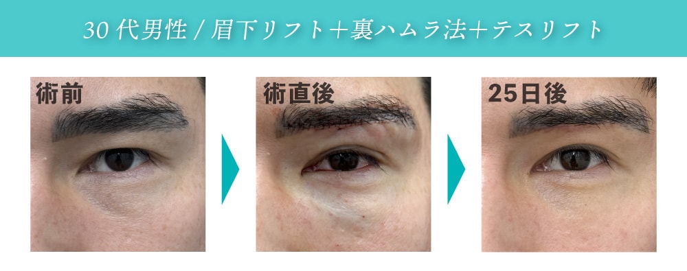 眉下リフトの傷跡は馴染むまでどのくらいかかりますか？<br />
