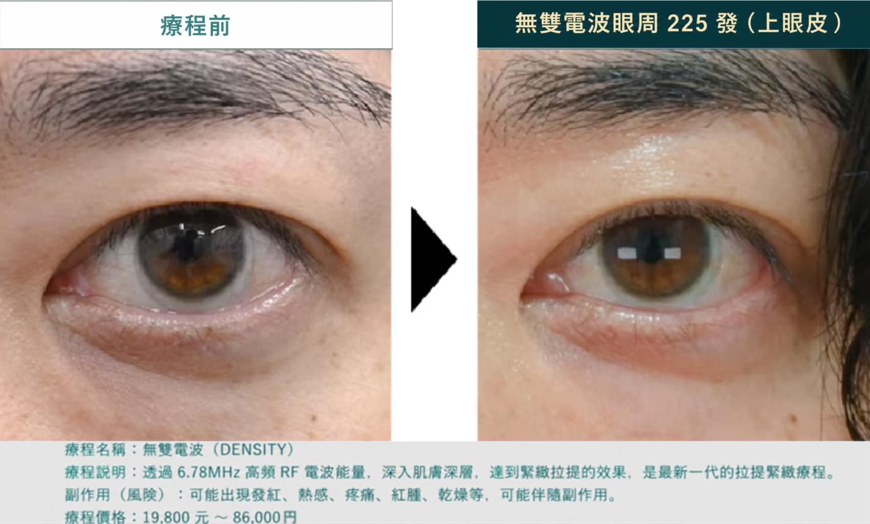 Density Eye，眼皮也能施作！