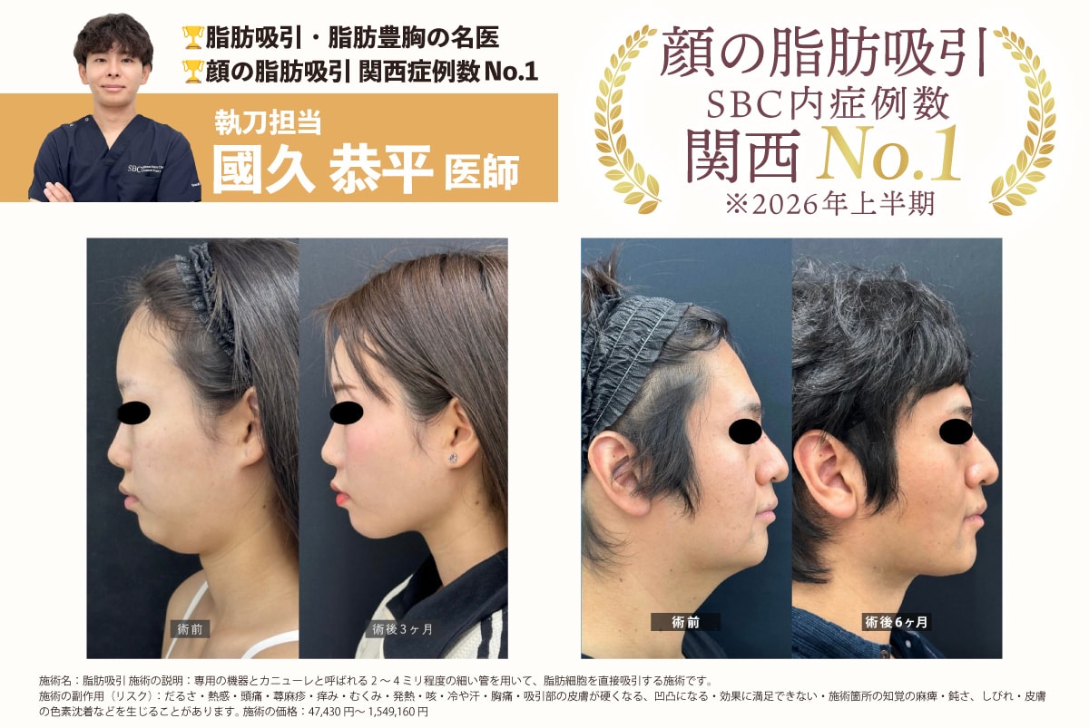 顔の脂肪吸引 症例写真