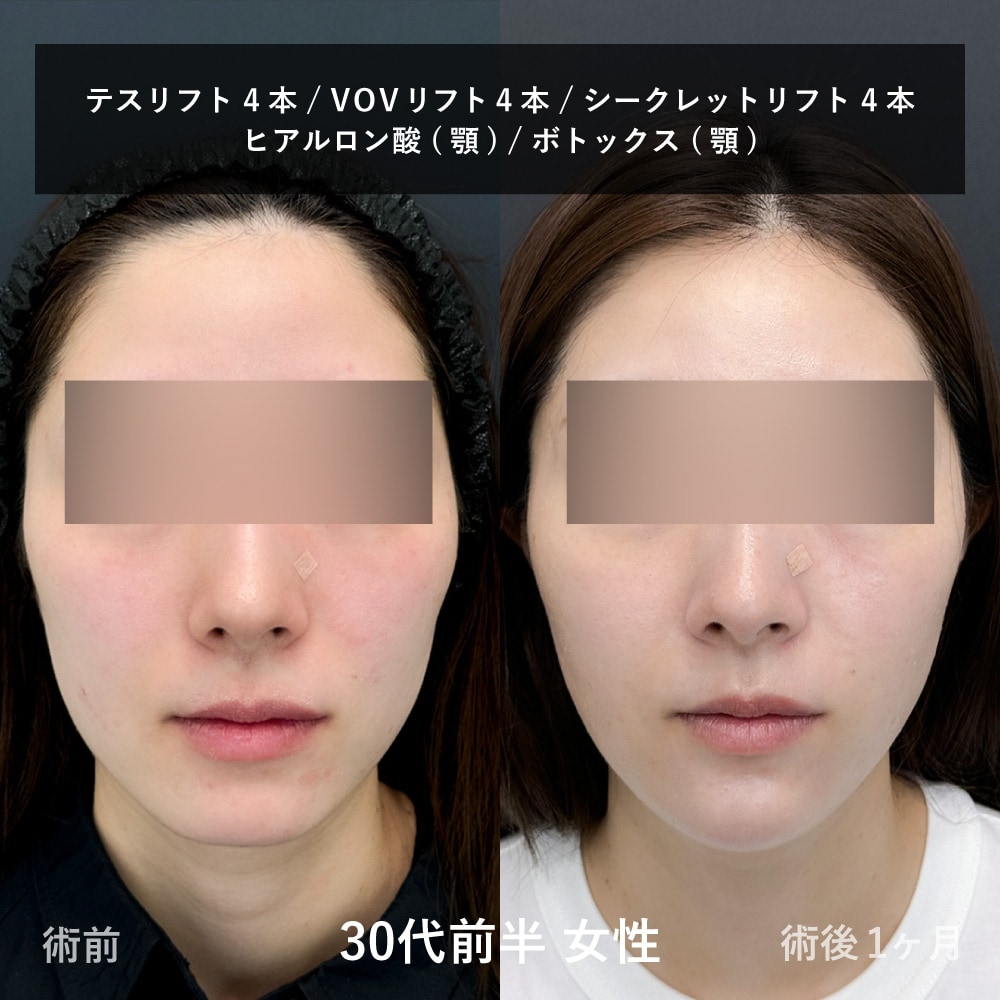 30代糸リフト正面画像