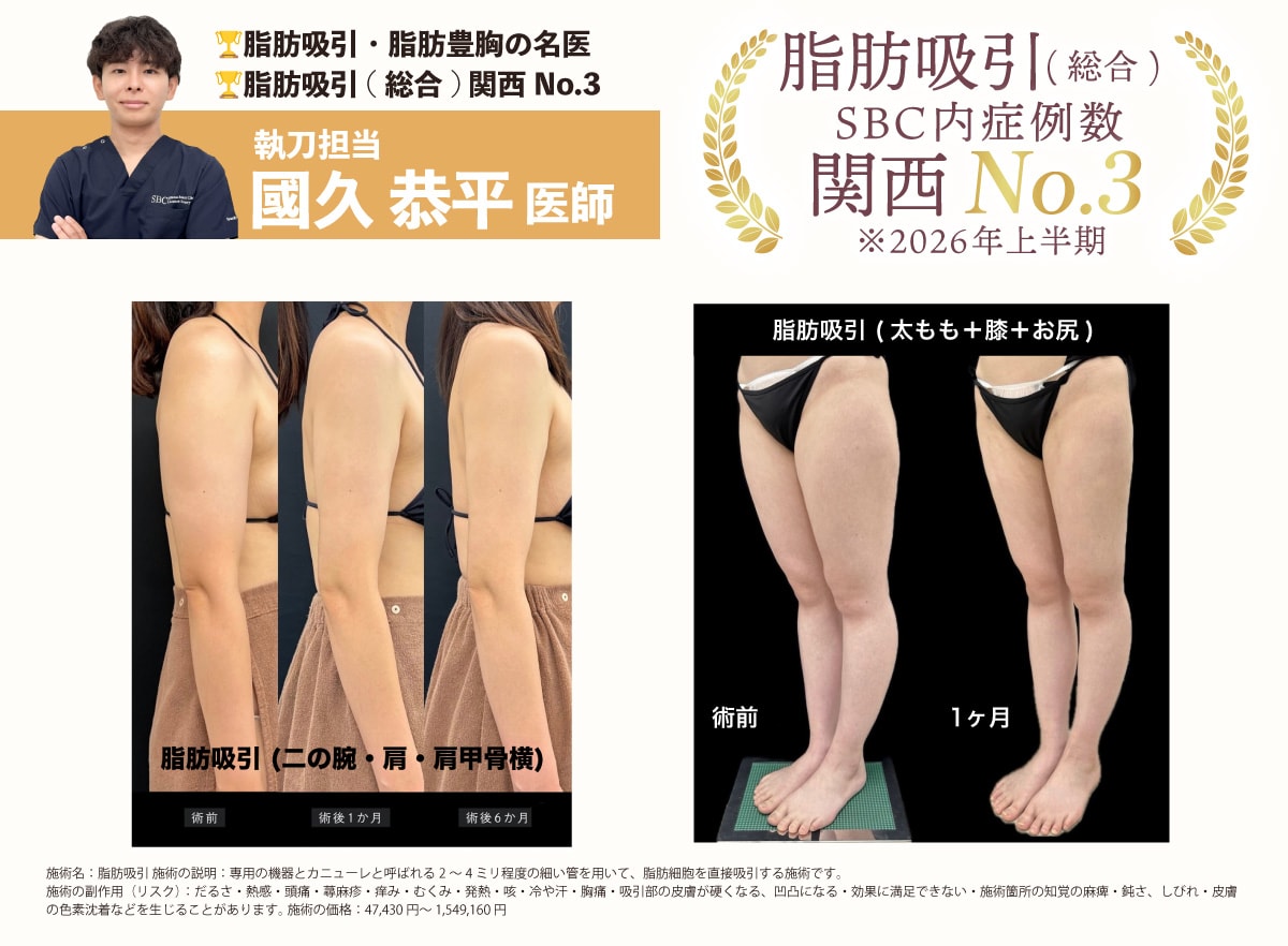 VASER脂肪吸引 症例写真