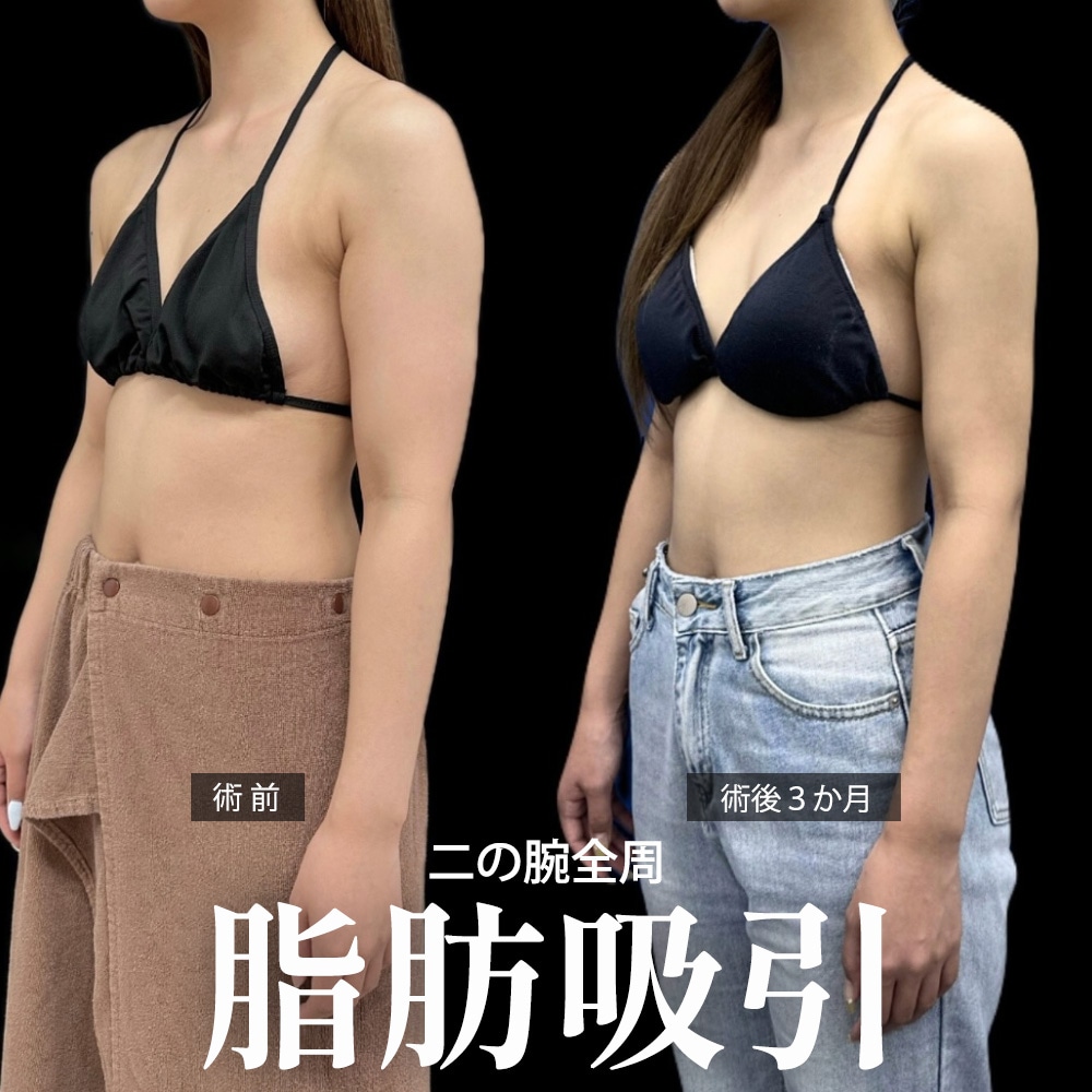 二の腕脂肪吸引 症例1