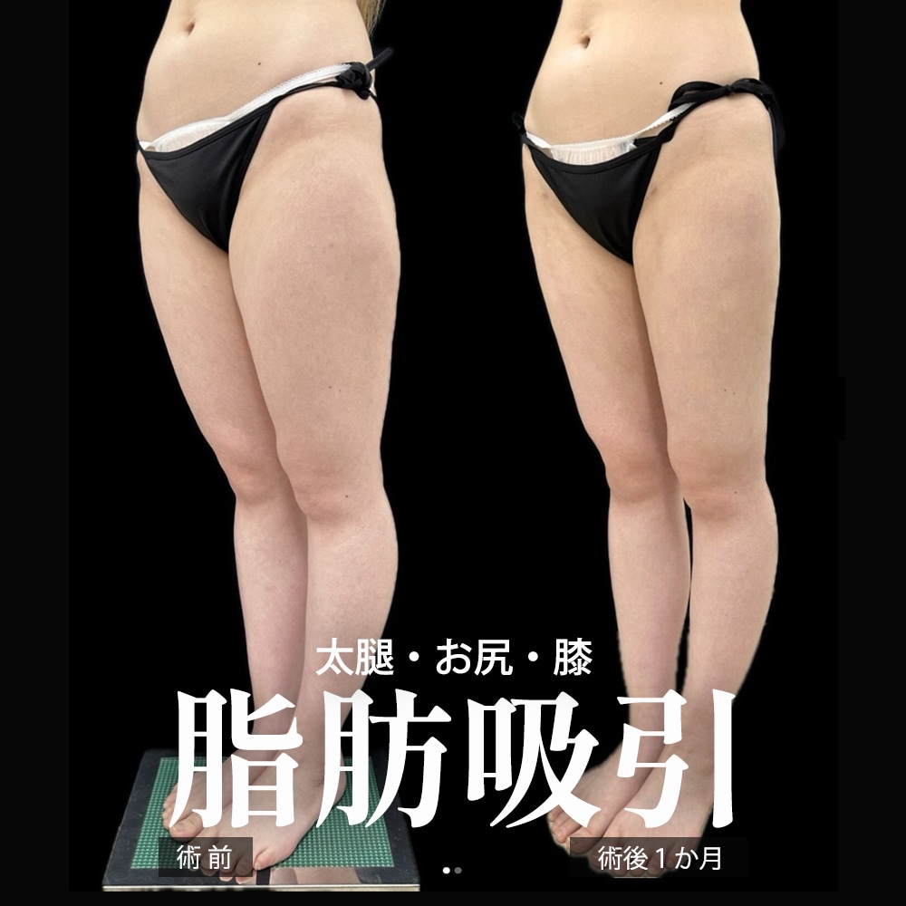 下半身脂肪吸引 症例1