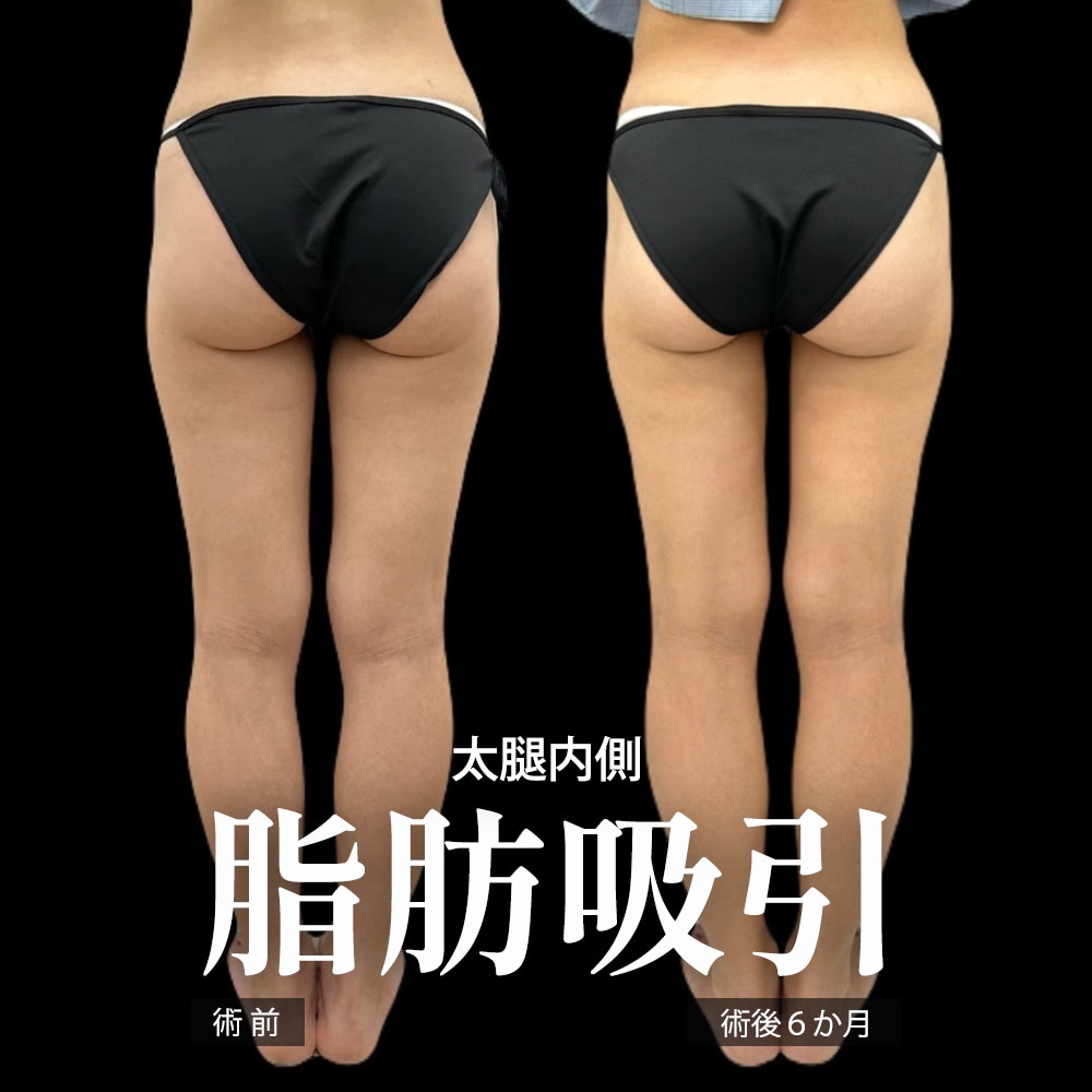 下半身の脂肪吸引 症例1