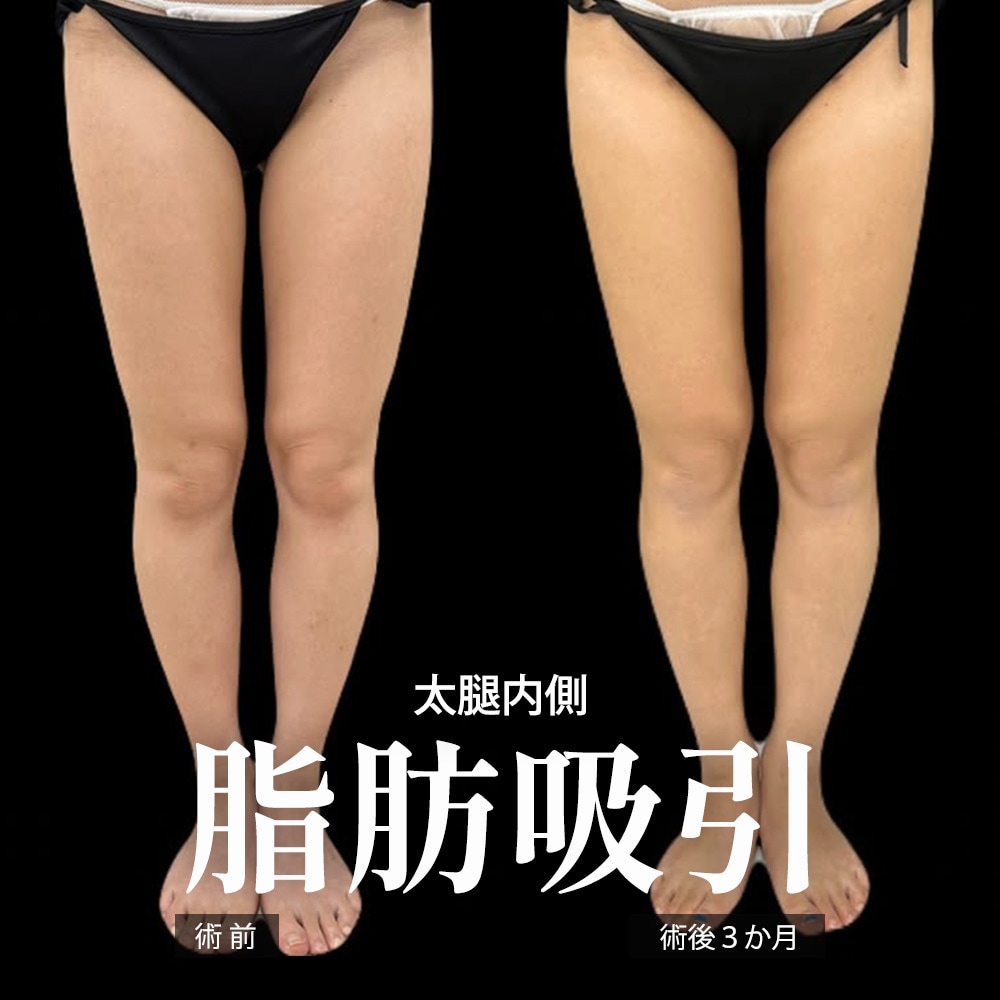 下半身の脂肪吸引 症例2