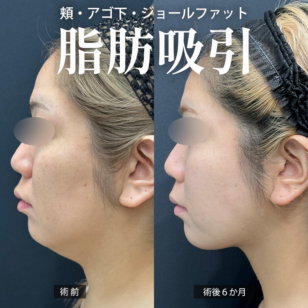 顔の脂肪吸引 症例1