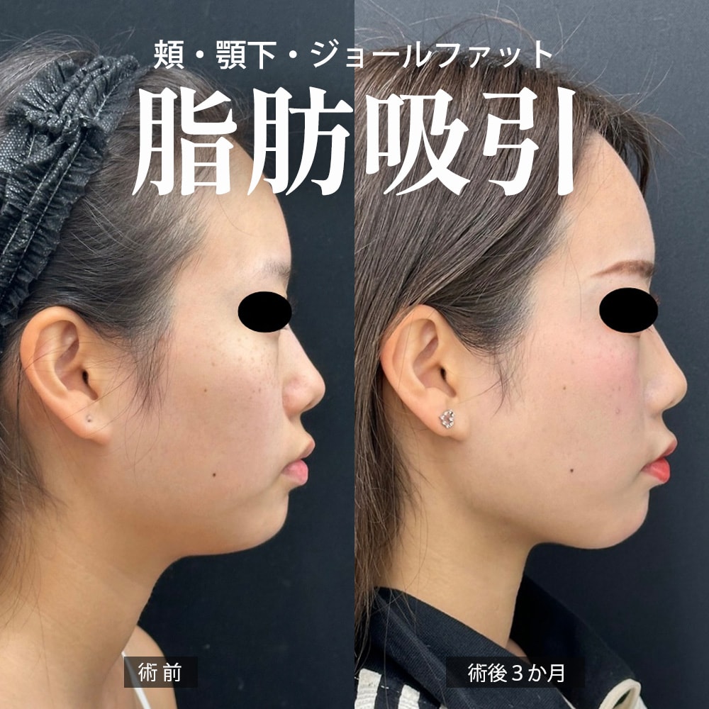 お顔の脂肪吸引 症例2