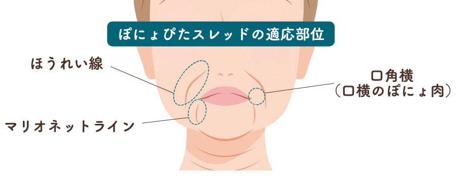 ぽにょぴたスレッドの適応箇所は？
