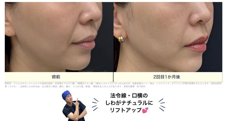 ジャルプロスーパーハイドロ
