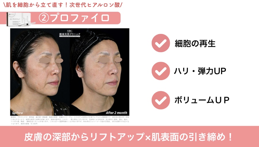その②プロファイロ<br />
