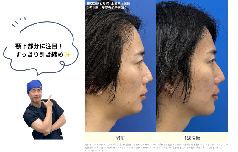 ボトックスリフト