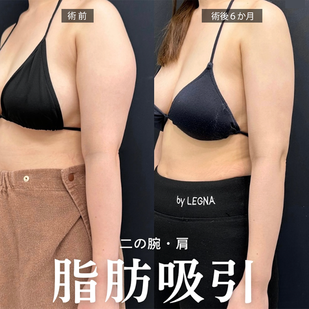 二の腕の脂肪吸引 症例1