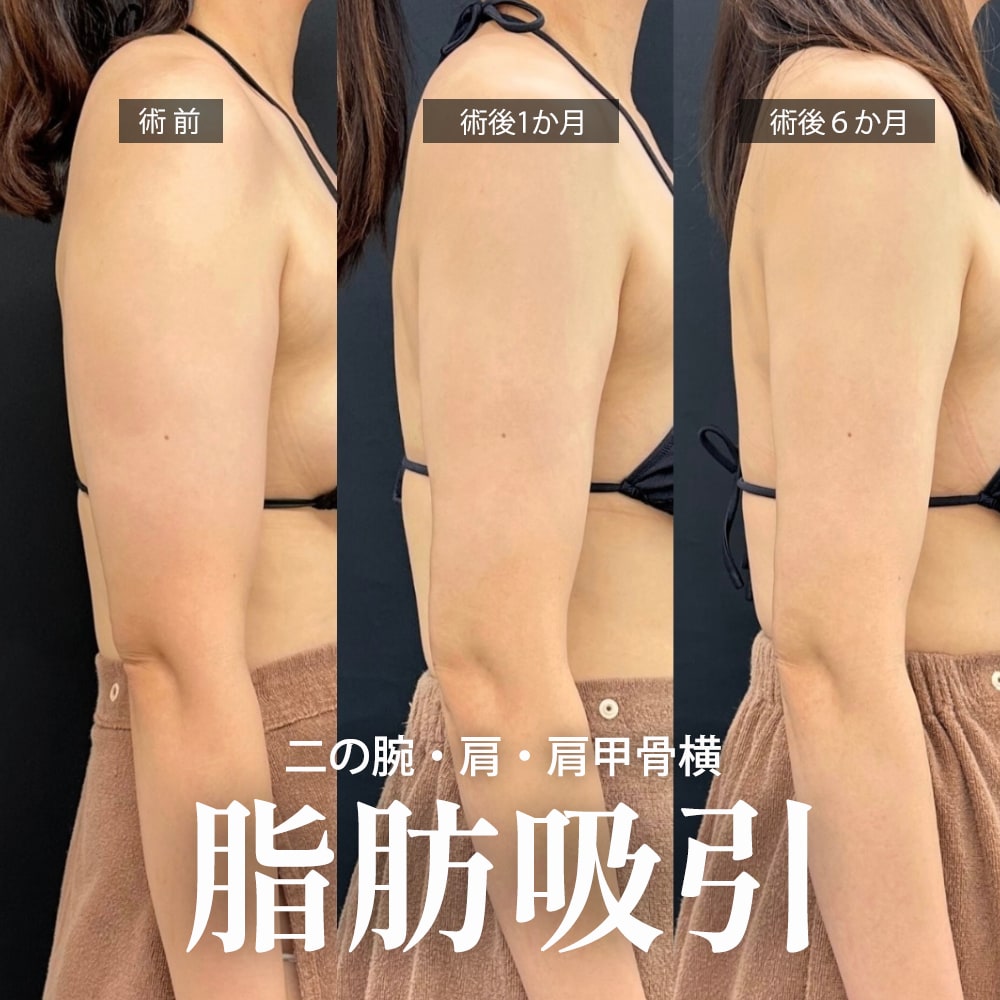 二の腕の脂肪吸引 症例2