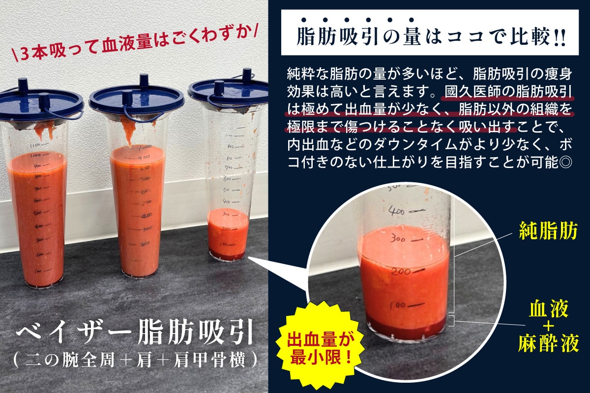 國久医師の脂肪吸引技術