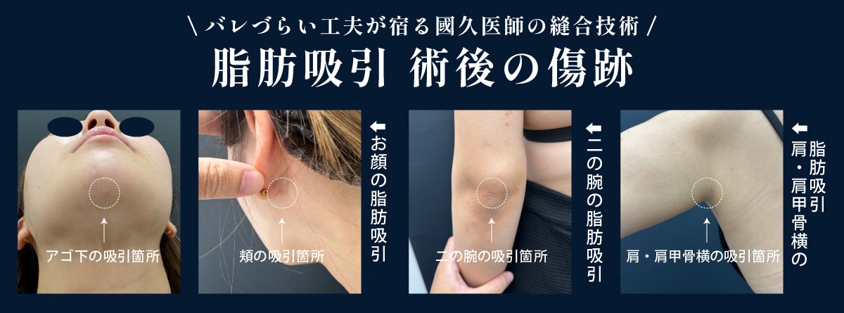傷跡の経過参考画像