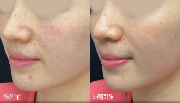 女優水光注射 症例写真