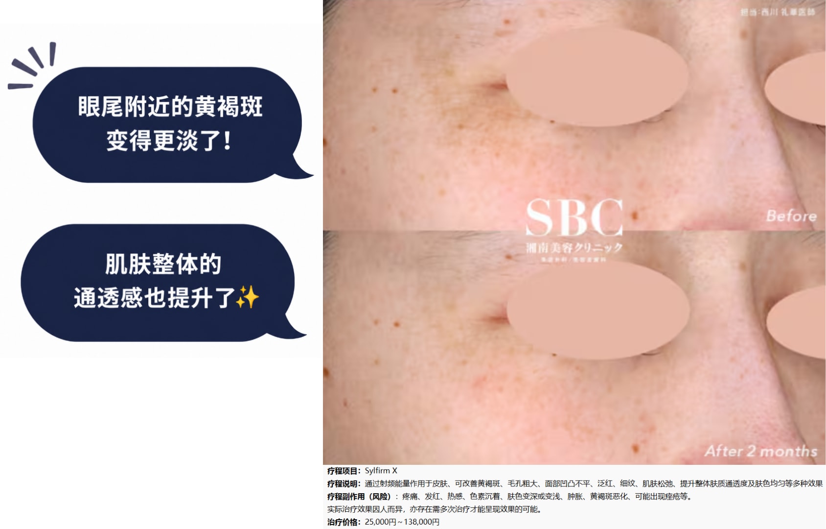 针对难以改善的黄褐斑！