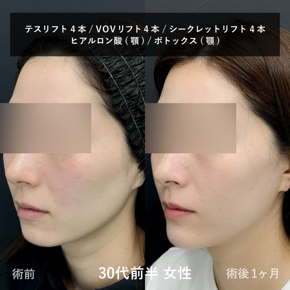 30代糸リフト斜め画像