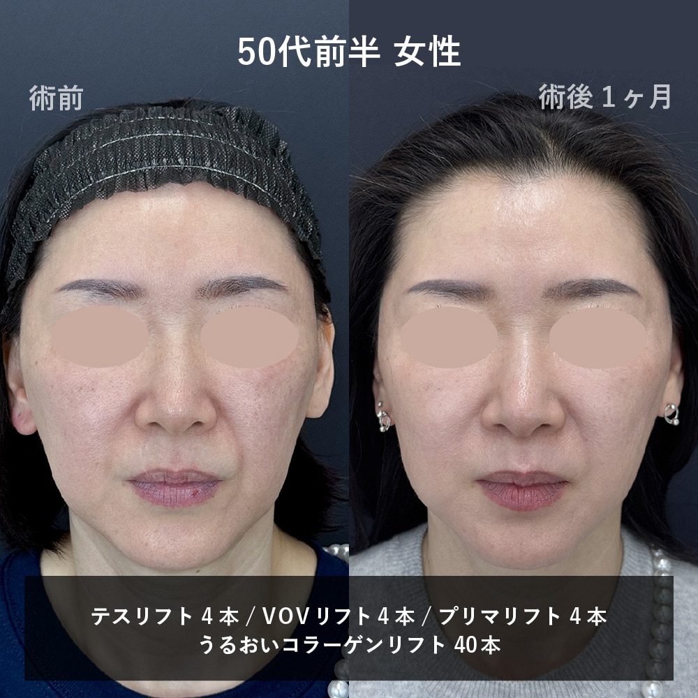 50代糸リフト正面画像