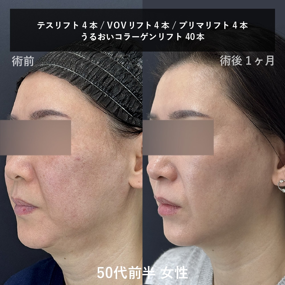 50代糸リフト斜め画像