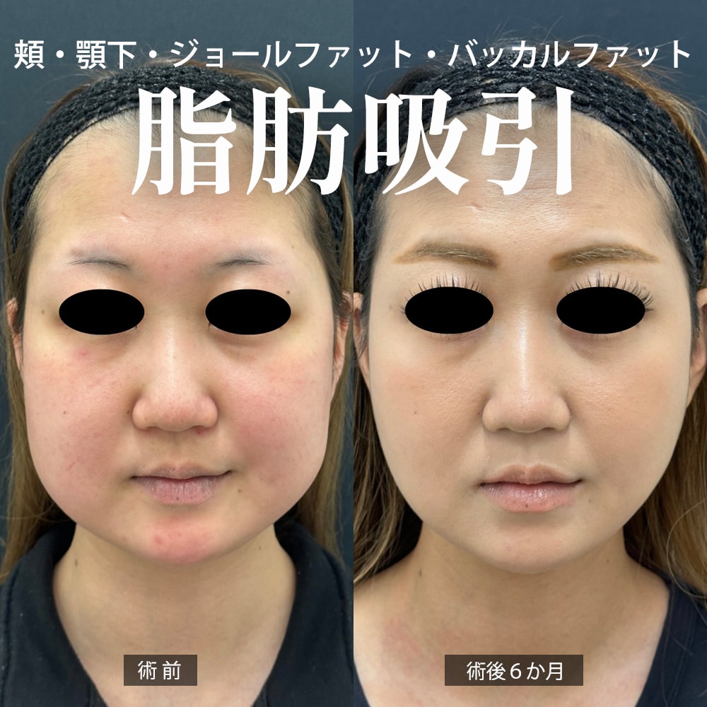 お顔の脂肪吸引 症例1